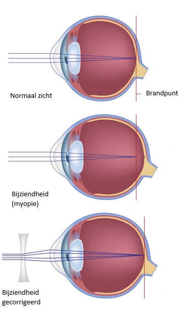 anatomie van oogbol met vormen bijziendheid