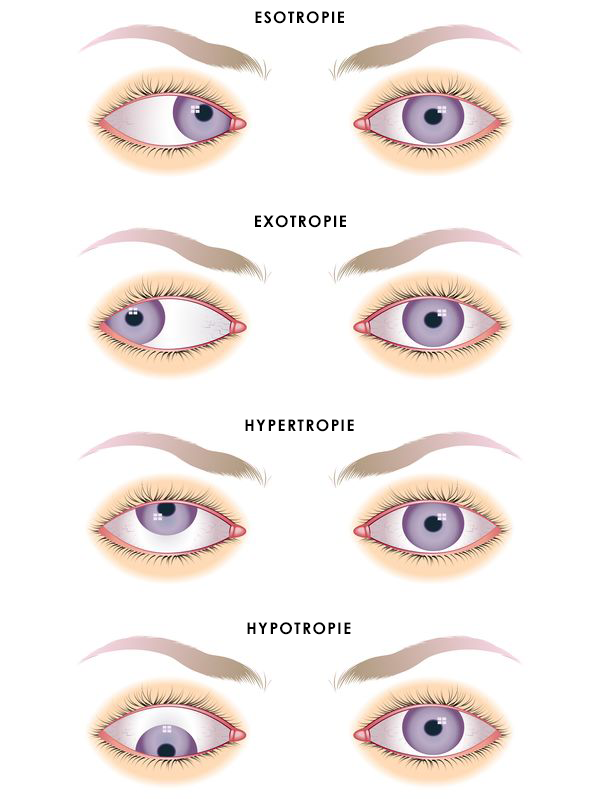 vier vormen van scheelzien ogen