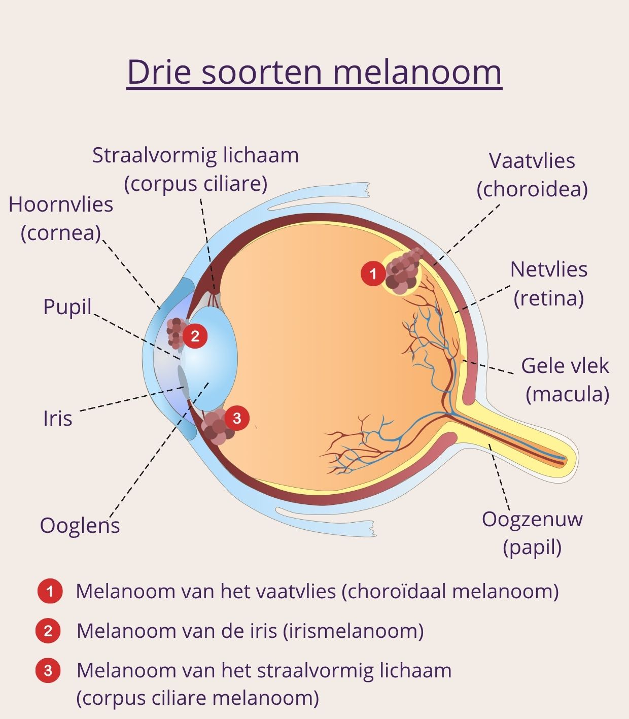 Afbeelding die drie soorten melanoom toont: Melanoom van het vaatvlies, melanoom van de iris en de melanoom van het straalvormig lichaam.