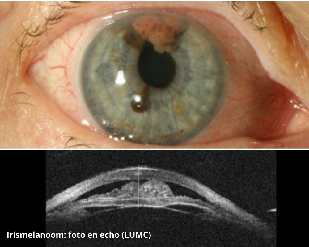 Foto waar een irismelanoom is afgebeeld