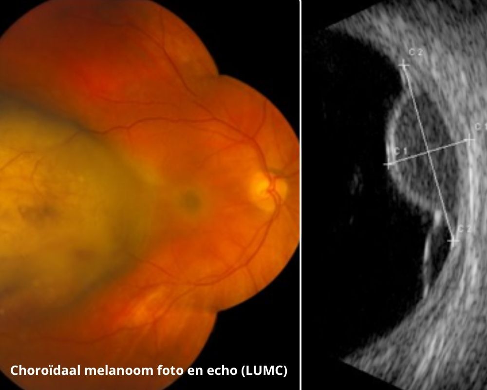 Echo-foto van een oogmelanoom