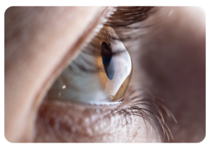 Een oog met keratocunus waarbij je duidelijk de kegelvorm ziet. 