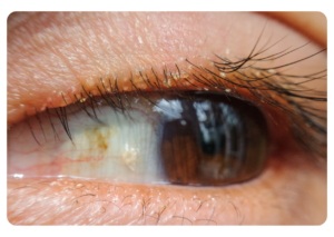 Close-up foto van blefaritis.