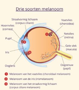 Een afbeelding waarin de verschillende vormen oogkanker zijn weergegeven.